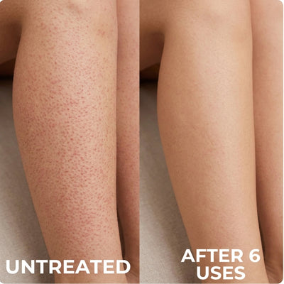 Advanced Triple Acid For Keratosis Pilaris
