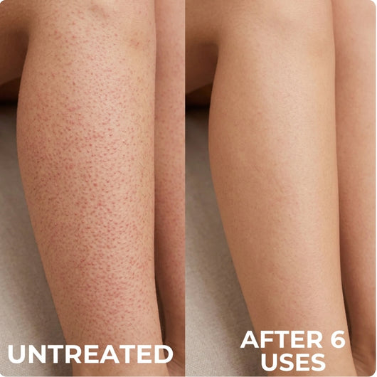 Advanced Triple Acid For Keratosis Pilaris
