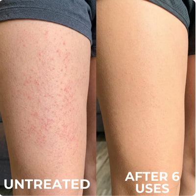 Advanced Triple Acid For Keratosis Pilaris