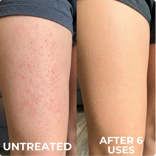 Advanced Triple Acid For Keratosis Pilaris