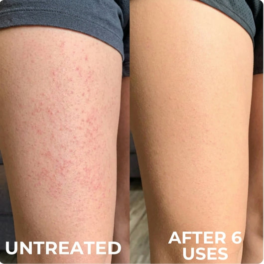 Advanced Triple Acid For Keratosis Pilaris