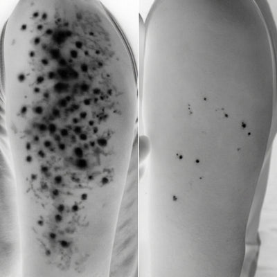 Advanced Triple Acid For Keratosis Pilaris