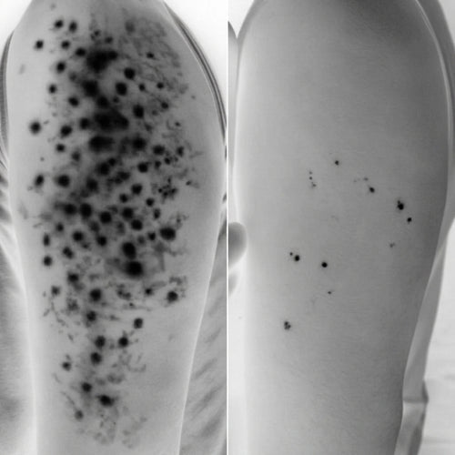 Advanced Triple Acid For Keratosis Pilaris