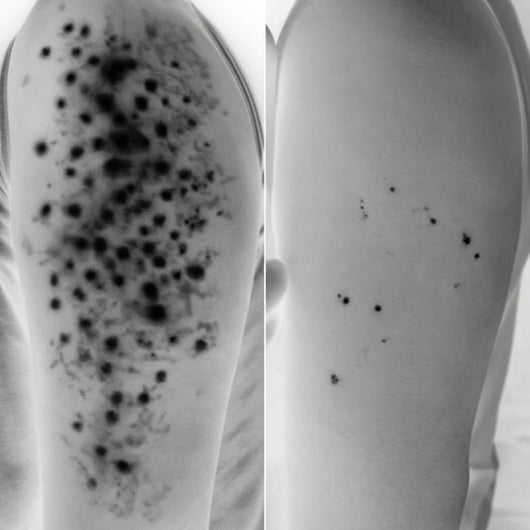 Advanced Triple Acid For Keratosis Pilaris