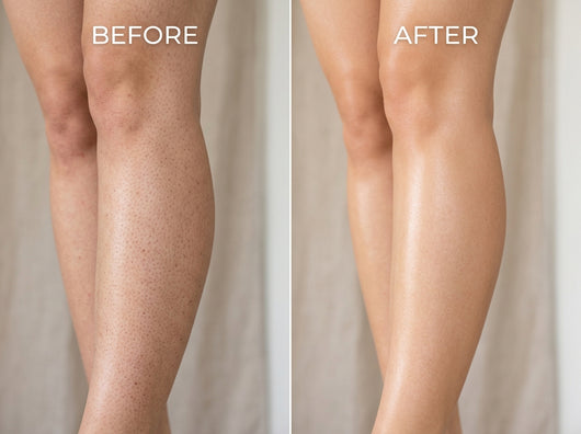 Advanced Triple Acid For Keratosis Pilaris